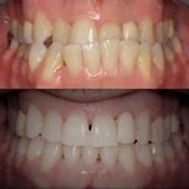 בן 41, יישור שיניים בקשתיות שקופות לתיקון מנשך הפוך ב29 חודשי טיפול.