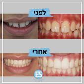 בת  14. יישור שיניים ברסן וגשר לשיניים לטיפול בשיניים בולטות ורווחים עליונים