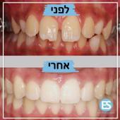 בת 13. יישור שיניים ברסן וגשר לשיניים לטיפול בשיניים בולטות ורווחים עליונים
