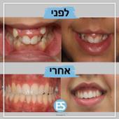 בת 13. יישור שיניים לטיפול בלסת עליונה בולטת, סגר עובר אופקי מוגדל וצפיפות
שיניים