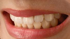 Керамические виниры для зубов 