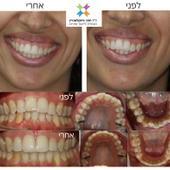 יישור שיניים בשיטת האינויזליין