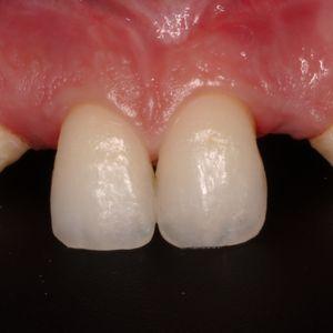 השלמות שיניים וציפויי חרסינה