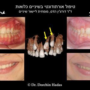 יישור שיניים במצב של שיניים כלואות