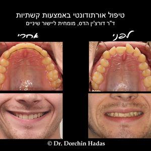 יישור שיניים באמצעות קשתיות (פלטות Invisalign)