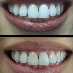 הלבנת שיניים במרפאה